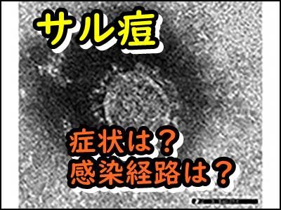 サル痘になぜなる?今さら聞けない名前の由来、症状や感染経路まとめ!